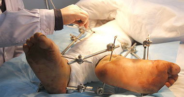 جراح عظام:التحميل على عضلات الساقين لفترات طويلة يسبب الكسر الإجهادى 